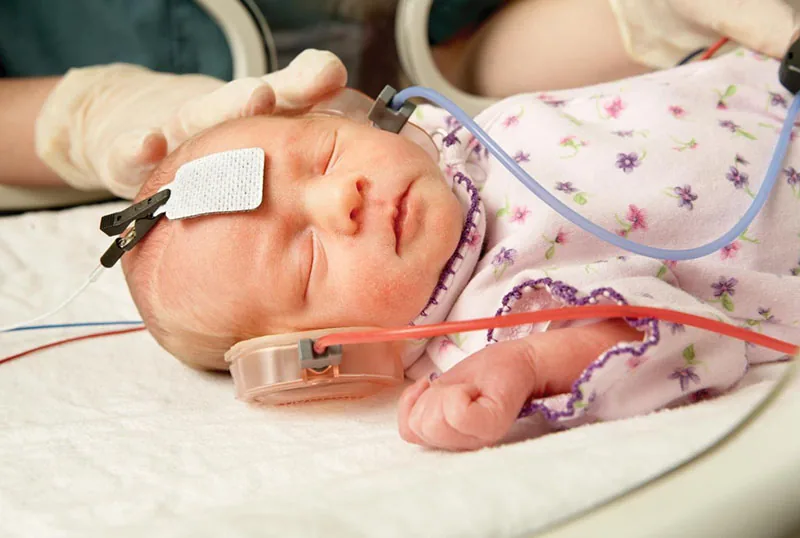 Newborn undergoing hearing screening with electrodes and earpiece